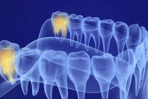 Wisdom Tooth Removal – A Detailed Guide